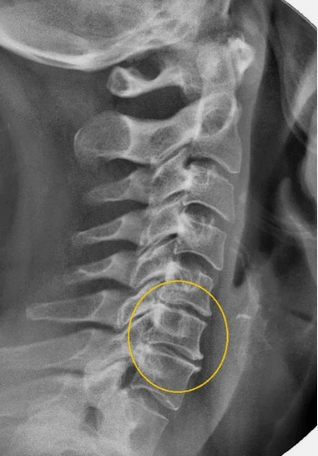 Osteochondroza coloanei vertebrale cervicale pe o rază X